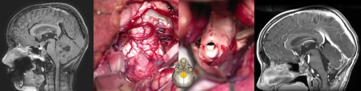 Bayet médullo méta