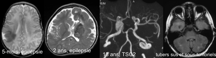Bourneville lésions SNC