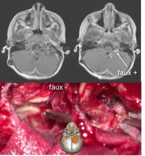 épendymome second look Christian
