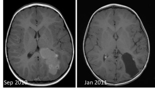 épendymome second look