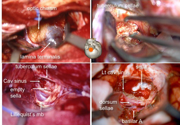 cranio voie sous-frontale 2