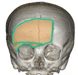 craniotomie