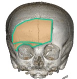 craniotomie