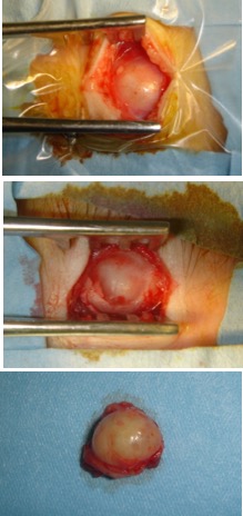 dermoïde résection