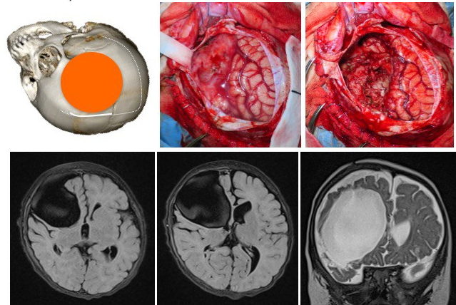 desmo Aubertin perop