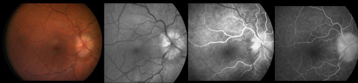 Diapositive15 angiofluo