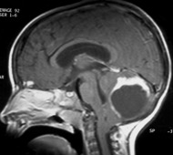 engagement tonsillaire