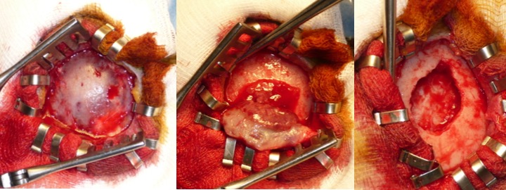 histiocytose résection