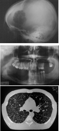 histiocytose systémique
