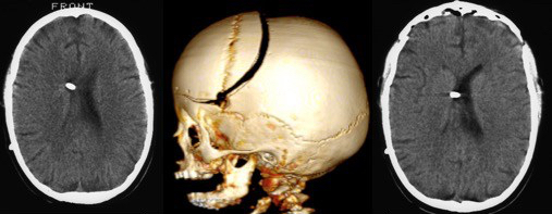 pseudo TC cranioplastie