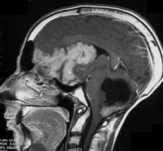 récidive métastatique