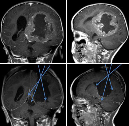 voie trans-pariétale