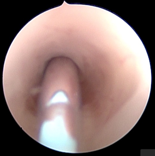 endo reperméation aq