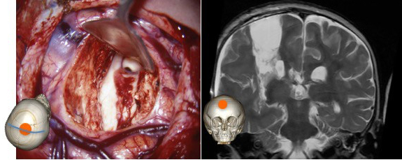 hémisphérotomie perop