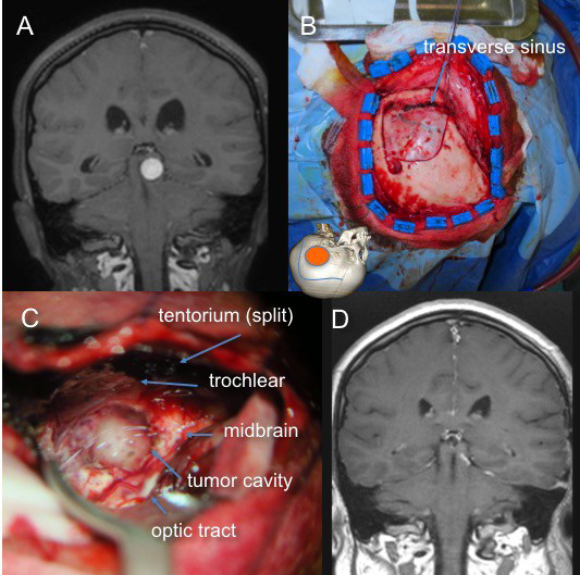 voie sous-temporale bis