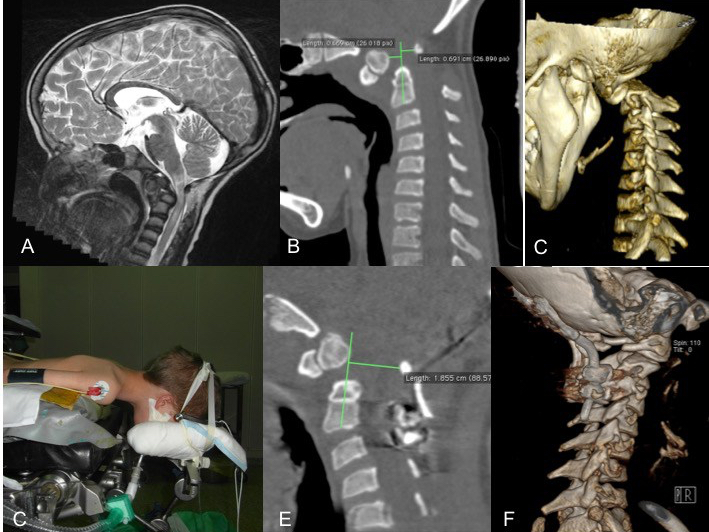 baude os odontoideum