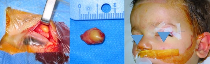 Bergues dermoïde sourcil