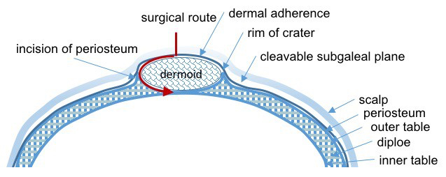 dermoid