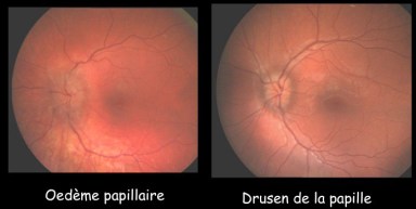 Diapositive10 drusen