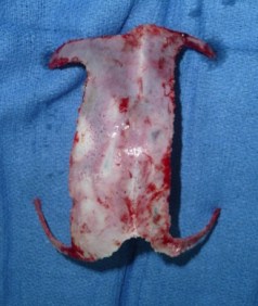 scapho craniectomie trop