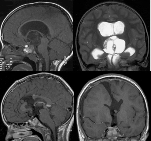 Verfaillie tératome