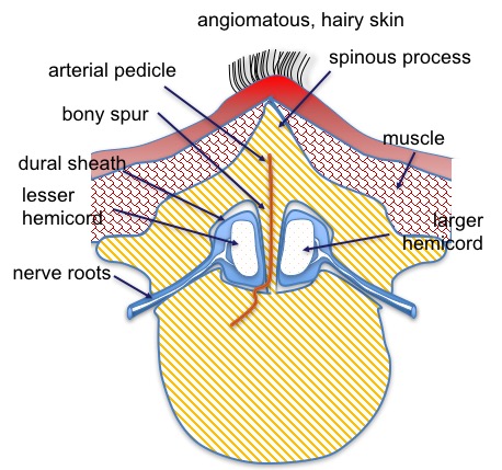diastématomyélie 1