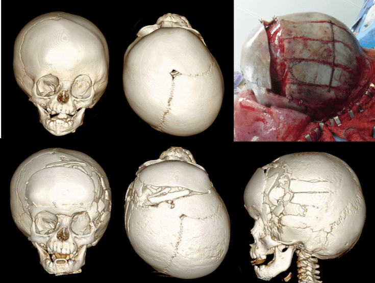 plagio berrel staves