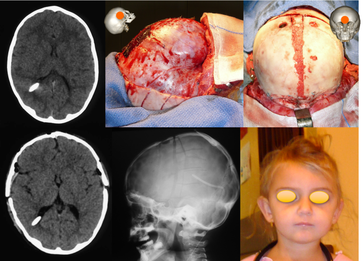 hyperdrainage craniosténose op