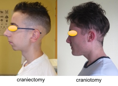 cranio-craniectomy