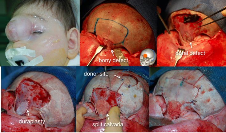 encephalocele F technique