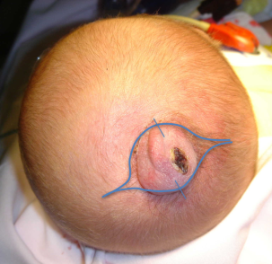 encephalocele vertex