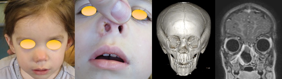 métopisme encphélocèle
