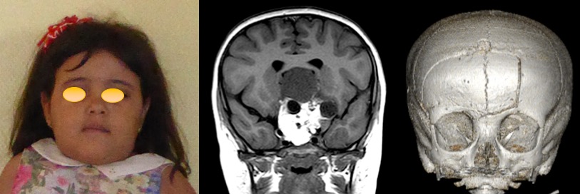 métopisme tératome