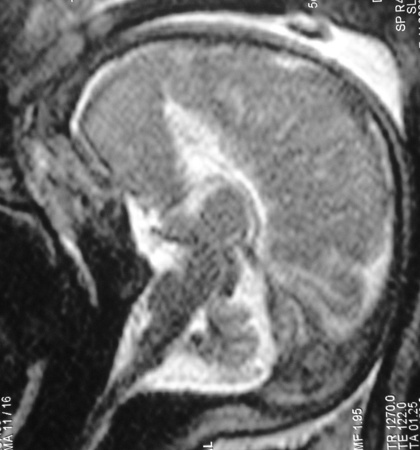 Depreux fille anténatal sagit.JPG