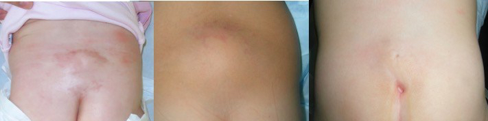 lipome postérieur peau