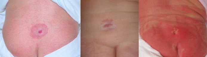 méningocèle manquée peau