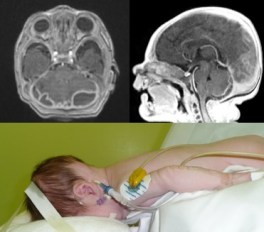 empyème nouveau-né