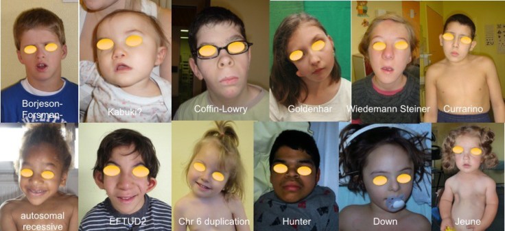 dysplaisie génétique