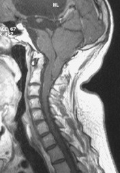chiari-2.jpg