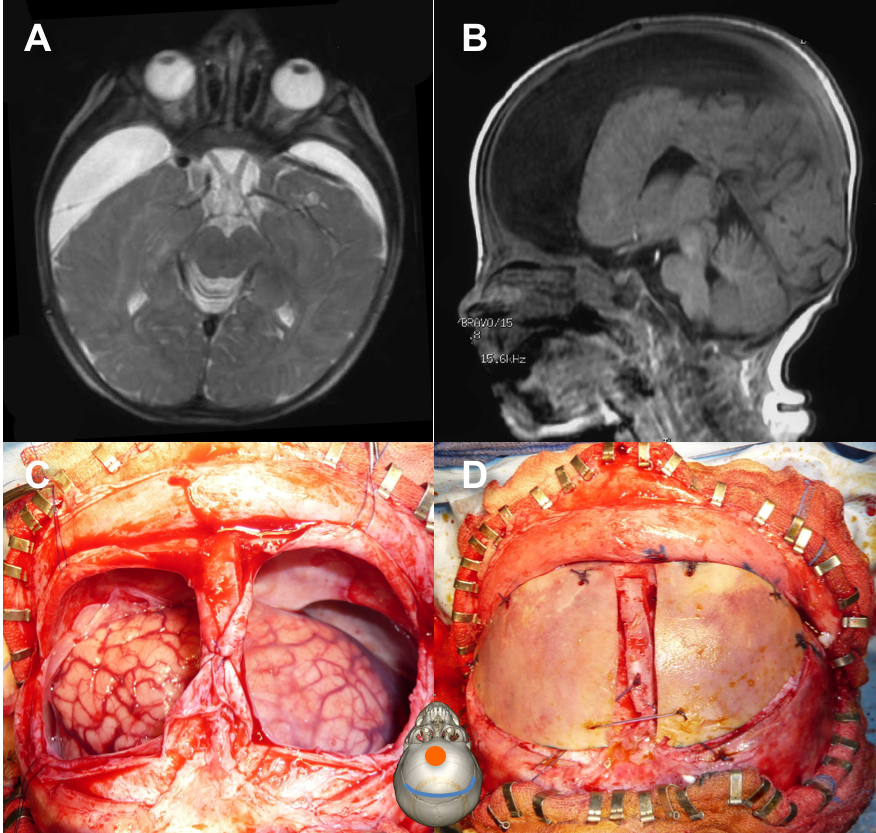 HSDC membranectomie 1