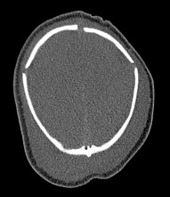 Akkabi Marwan céphalhématome scapho
