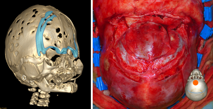 cloverleaf perifrontal bis