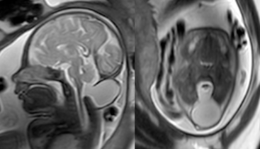 encéphalocèle DAN Wacogne