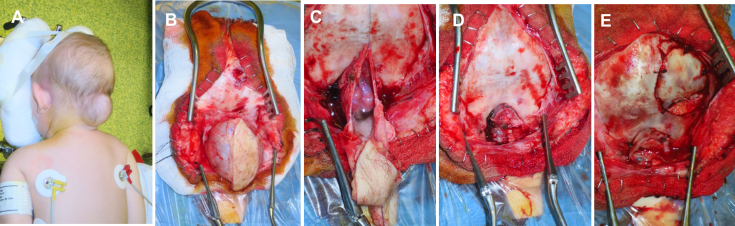 encéphalocèle perop Wacogne