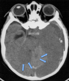 engagement cruciata.png