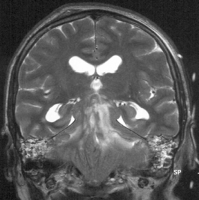 engagement culmen Maczak