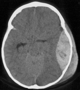 engagement ischémie