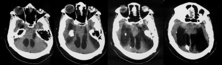 engagement rétro-mésencéphalique