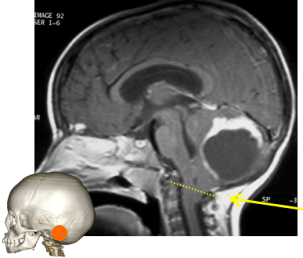 engagement tonsillaire