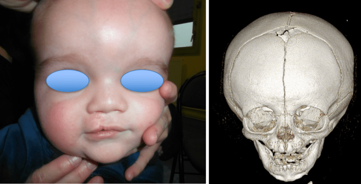 ffistule DN linge médiane